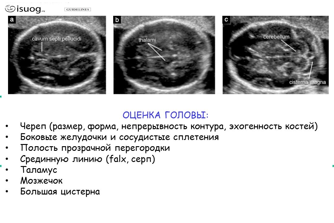 Большая цистерна больше нормы. Полость прозрачной перегородки у плода норма. Полость Верге у плода на УЗИ. Полость прозрачной перегородки на УЗИ.