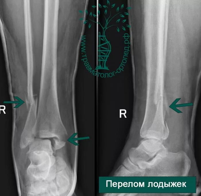 Перелом лодыжки форум вумен. Перелом внешней лодыжки рентген. Перелом берцовой кости рентген. Перелом наружная лодыжка рентгенограмма. Перелом лодыжки внешней кости.