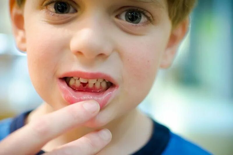 Ребенку 2 года 12 зубов. Катаральный гингивит у детей. Ювенильный гипертрофический гингивит.