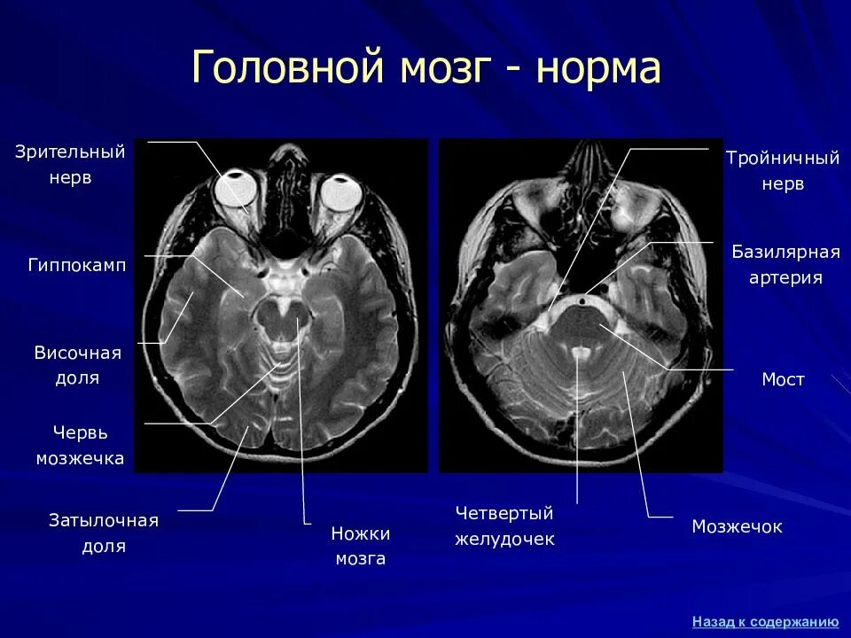 Можно по кт определить. Мрт норма анатомия головного мозга. Желудочки головного мозга анатомия мрт. Мрт анатомия головного мозга средний мозг. Доли головного мозга на кт анатомия.