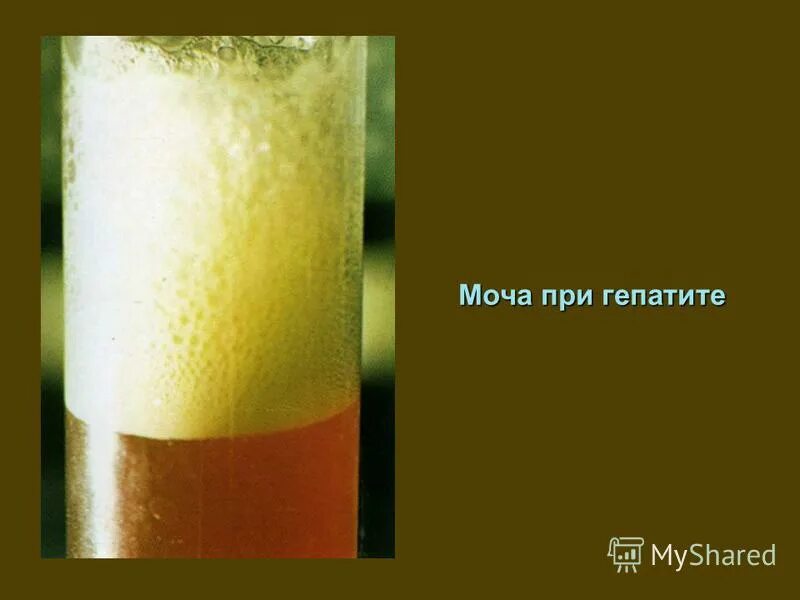 Расшифровка анализа мочи взрослого человека: показатели, норма и отклонения