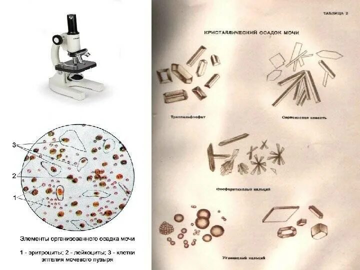 Струвиты в моче микроскопия. Микроскопия осадка мочи трипельфосфаты. Микроскопия кала трипельфосфаты. Струвиты микроскопия.