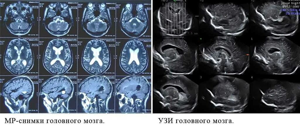 Чем отличается узи от мрт