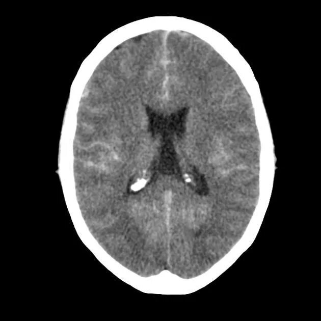 кт субарахноидальное гематома. субарахноидальный инсульт кт. субарахноидальное кровоизлияние на кт. субарахноидальное кровоизлияние на кт. субарахноидальное кровоизлияние на кт.
