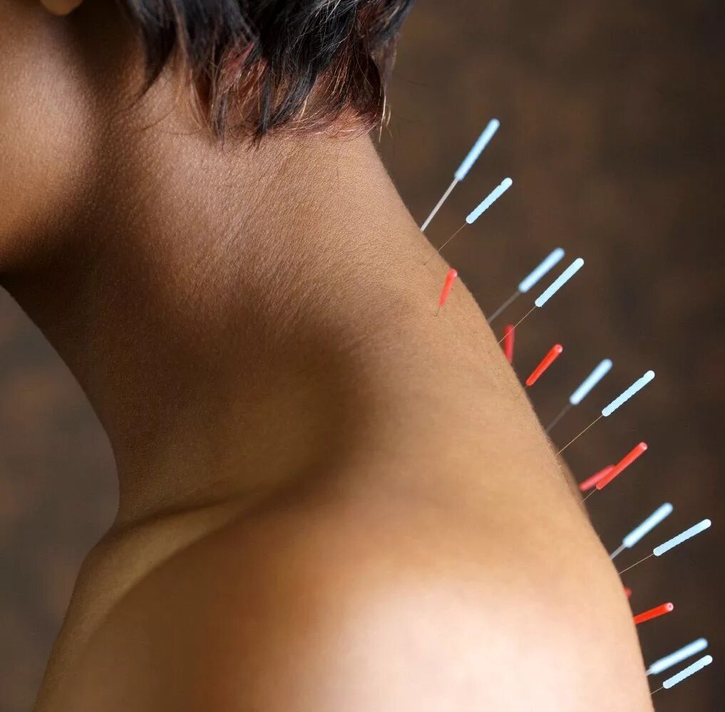 Акупунктура позвоночника. Электроакупунктура (рефлексотерапия) -. Рефлексотерапия. Иглотерапия при остеохондрозе поясничного отдела. Иглотерапия грыжа позвоночника.