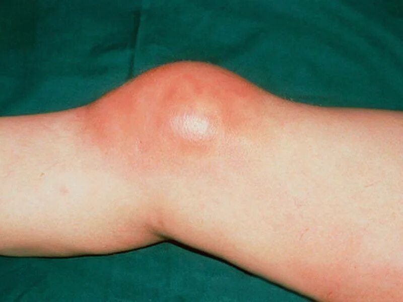 Препателлярный бурсит. Как лечить воспаление под. Принципы лечения воспаления патофизиология. Антибиотики при воспалении лимфоузлов на шее. Бурсит воспаление суставной сумки.