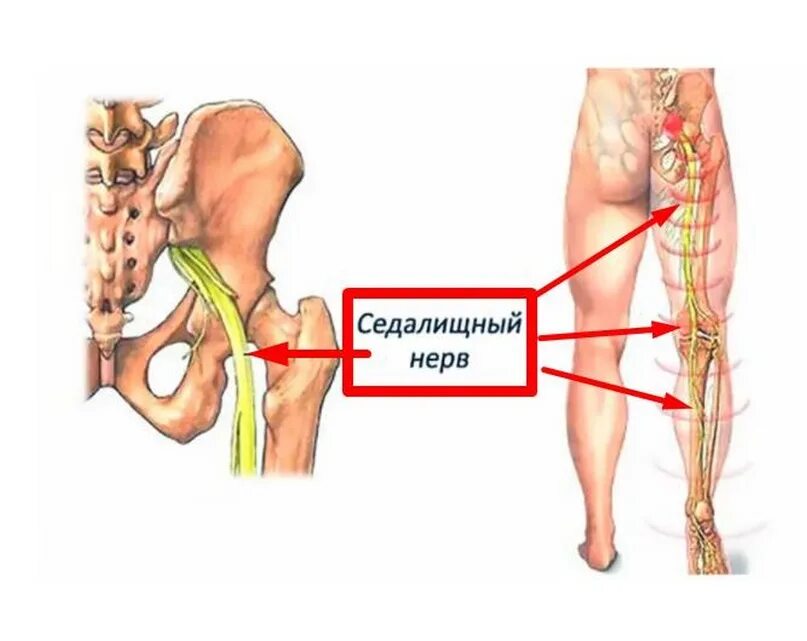 Седалищный нерв схема расположения. Защемление седалищного нерва. Защемление седалищного нерва анатомия. Ишиас - защемление седалищного нерва. Как вылечить защемление седалищного нерва