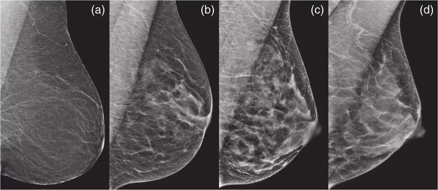 Диффузно фиброзная мастопатия bi rads 2. Фиброзная мастопатия маммограмма. Фиброзно Узловая мастопатия. Фиброзная мастопатия на маммографии. Узловая мастопатия маммограмма.