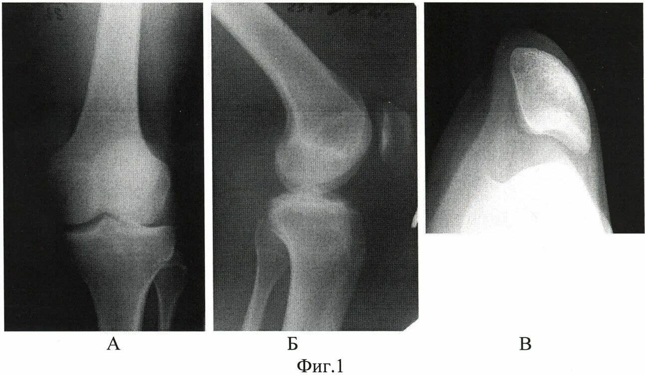 Латерализация надколенника. Вывих надколенника рентген. Перелом надколенника рентген. Врожденный вывих (латеропозиция) надколенника. Врожденный вывих надколенника травматология.