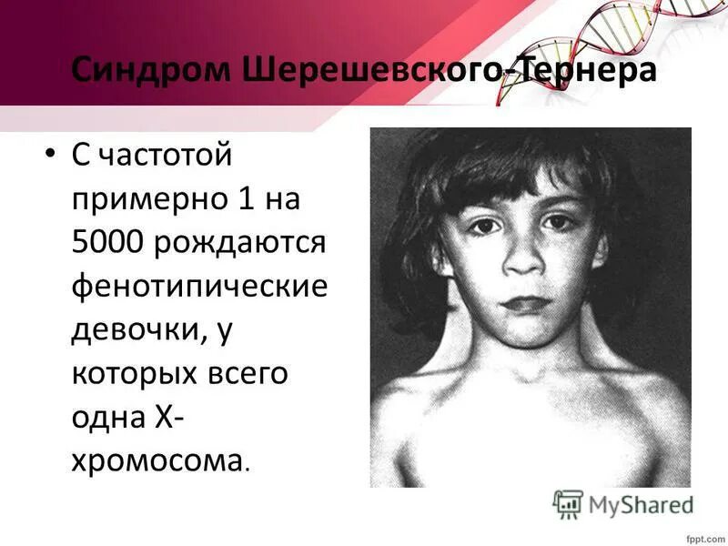 Синдром тернера мкб 10. Синдром шерешевского тернера. фенотипическая характеристика синдрома шерешевского тернера.