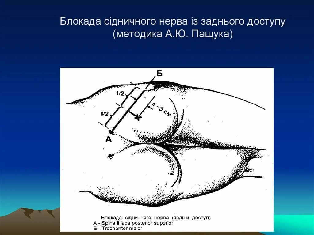 Нервная блокада. Новокаиновая блокада бедренного нерва. Проводниковая блокада седалищного нерва.