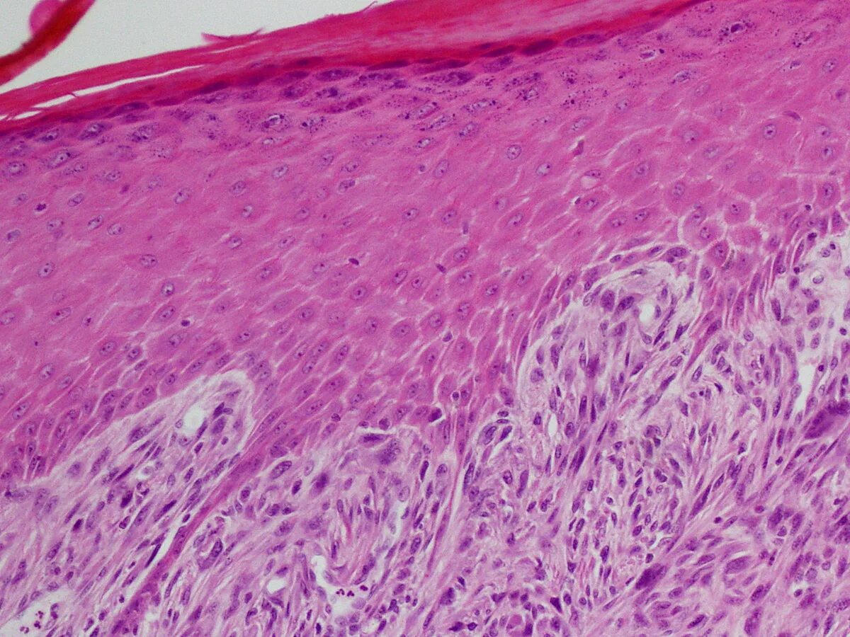 Гистология фото. Плоскоклеточная карцинома squamous cell carcinoma. плоскоклеточный эпителий. плоскоклеточный кератоз гистология. веретеноклеточная саркома кожи.
