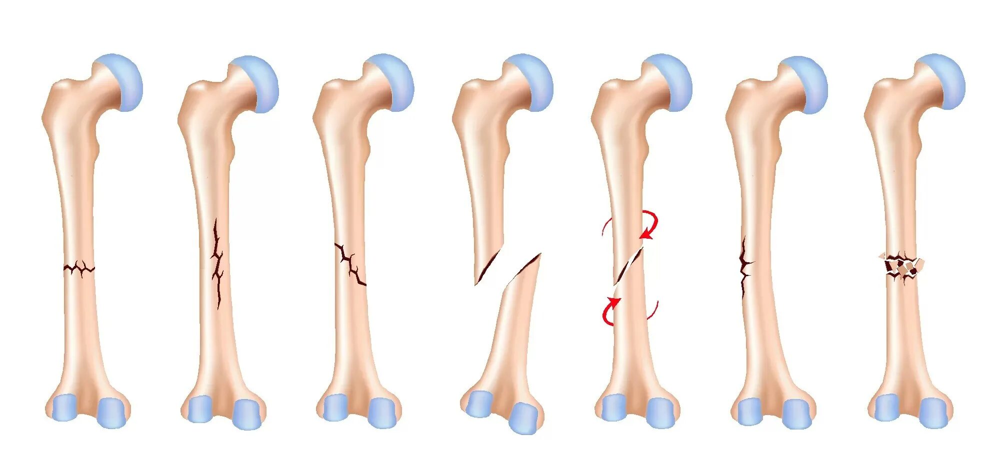 Перелом кости может быть каким. Классификация переломов трубчатых костей. Классификация переломов по форме и направлению перелома. Переломы по характеру излома.