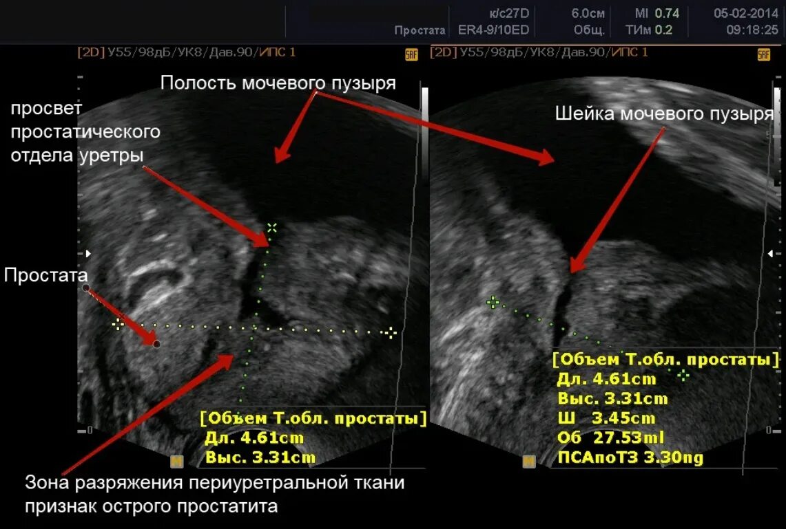 Простатит у детей. УЗИ предстательной железы простатит. Объем предстательной железы на УЗИ. УЗИ предстательной железы норма. Ультразвуковое исследование предстательной железы трансректально.