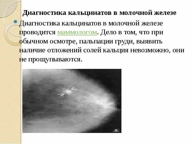 Что значит кальцинат в молочной железе. Внутрипротоковые кальцинаты молочных желез. макрокальцинаты молочной железы. микрокальцинаты в молочной железе. протоковые кальцинаты в молочной железе.