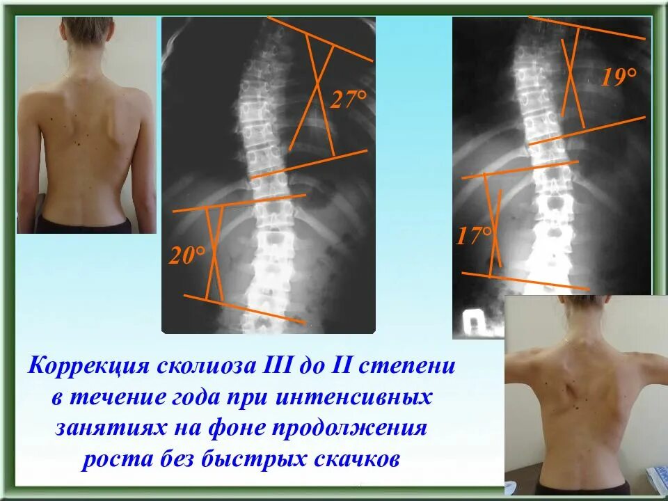 Искривление позвоночника градусы. Степени сколиоза. Поясничный сколиоз 3 степени.