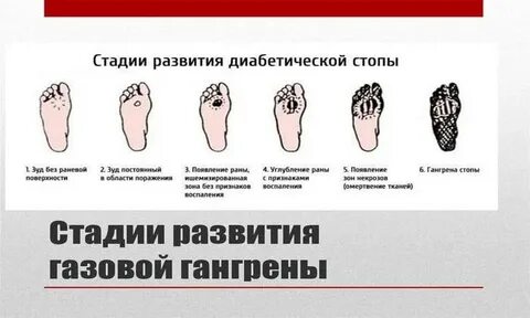 Признаки сахарной стопы