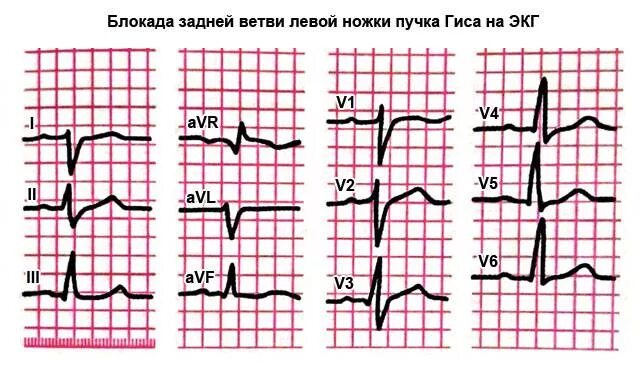 Блокада левой ножки пучка гиса на экг. Блокада левой ножки п Гиса на ЭКГ. Блокада ПНПГ И задней ветви ЛНПГ на ЭКГ. Блокада задней ножки пучка Гиса. Блокада правой ножки пучка Гиса по ЭКГ.