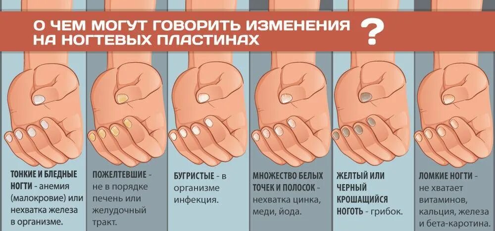 Заболевания как определить по человеку. Диагностика по ногтям. выявление болезни по ногтям. как определить заболеваемость по ногтям. определить болезнь по ногтям.