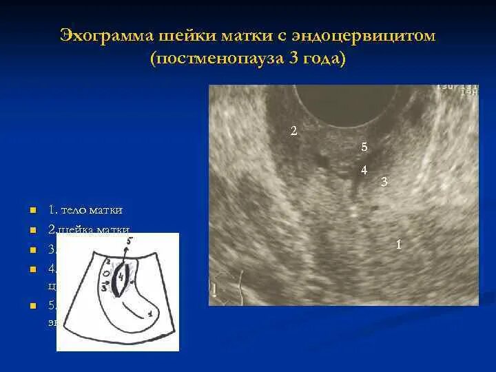 Хронический эндоцервицит что это. Хронический эндоцервицит по УЗИ. УЗИ признаки эндоцервицита. Эндоцервицит, эндометрит. Эндоцервицит шейки матки УЗИ.