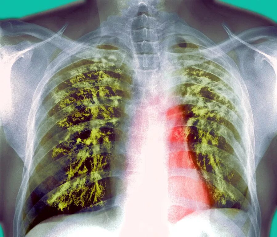 Туберкулез tuberculosis. Туберкулез воспаление. Лёгкие поражённые туберкулёзом.