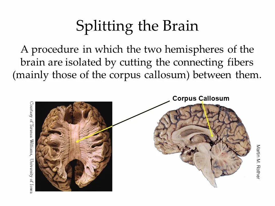 Corpus callosum Fibers.