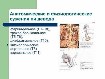 Сужения пищевода