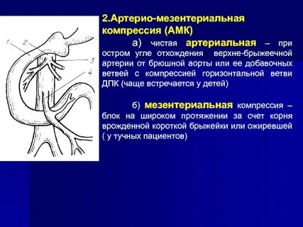 Аорто мезентериальная