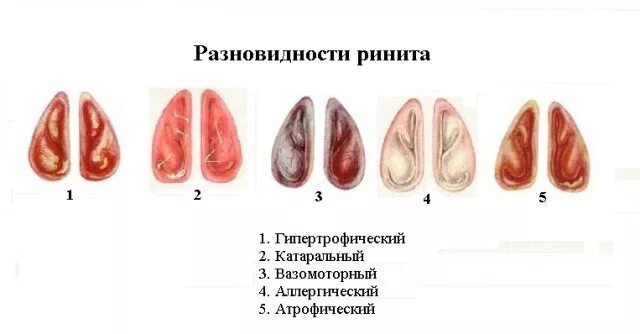 Хронический гипертрофический и вазомоторный ринит. Хронический вазомоторный ринит. Гипертрофический ринит и атрофический. Острый вазомоторный ринит. Острый катаральный ринит