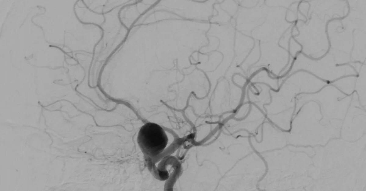 Аневризма головного мозга эндоваскулярным. Аневризма головного сосудов головного мозга. Эндоваскулярная аневризма головного мозга. Аневризма артерии головного мозга. Аневризма и разрыв сосуда головного мозга.