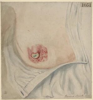 Paget's disease of the nipple Wellcome L0062175.jpg. 