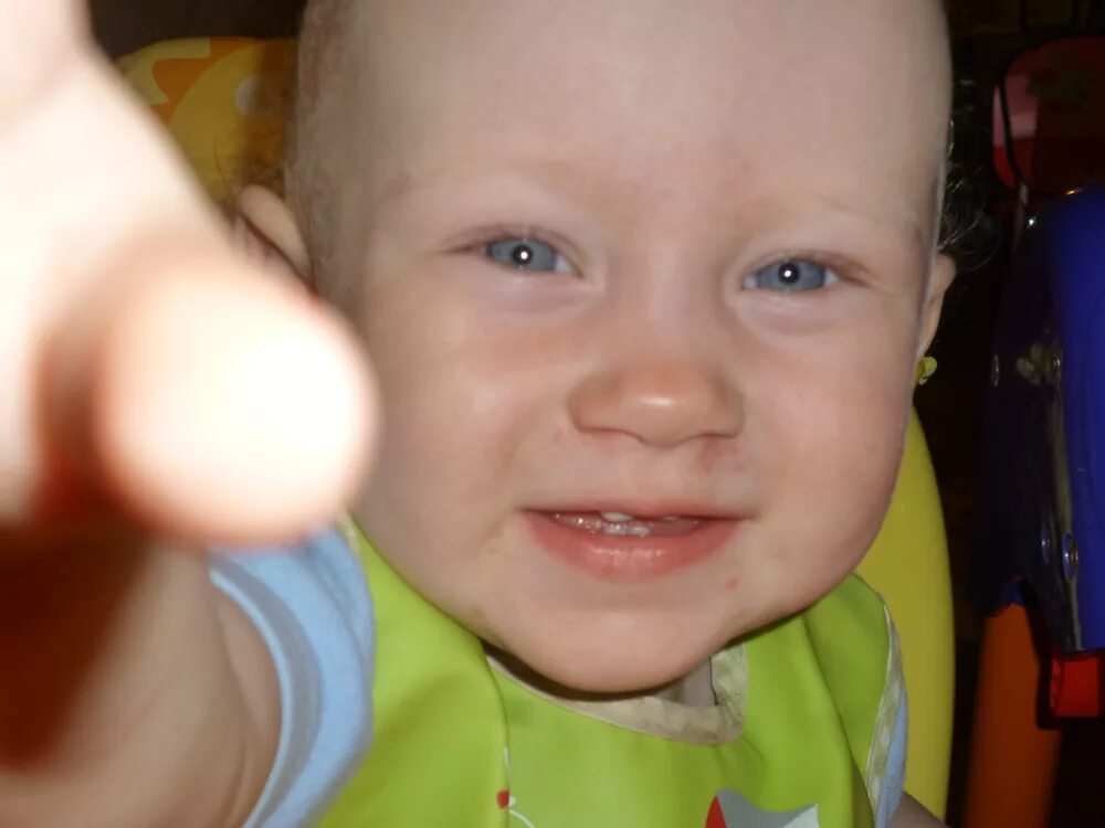 Синеет переносице. Цианоз носогубного треугольника. Синеет переносице. Ушиб переносицы у ребенка. Реснички и брови у грудничка.