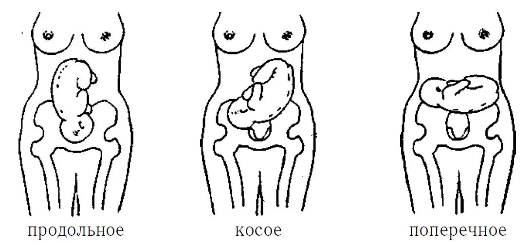 Продольное косое поперечное расположение плода. Косое положение плода при беременности. Поперечные и косые положения плода. Продольное косое положение плода. Ребенок расположен справа