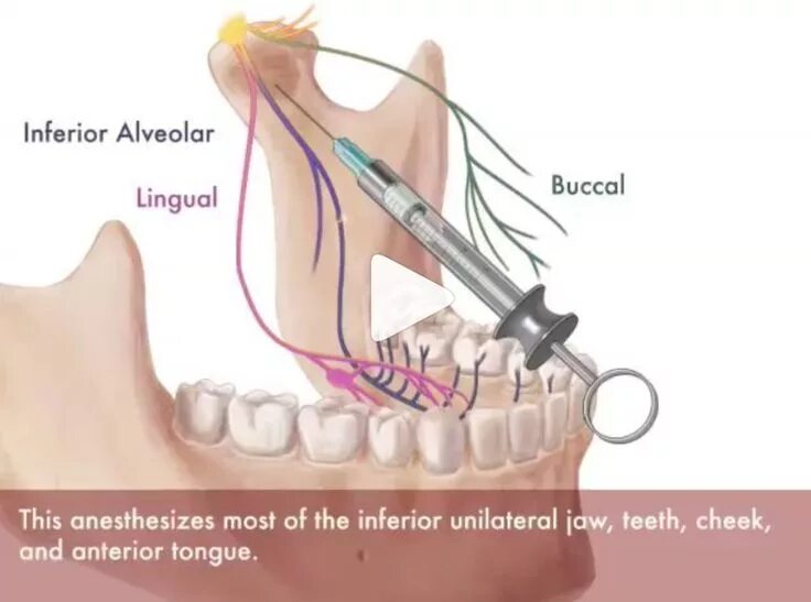 Туберальная анестезия верхней блокада нервов. Торусальная анестезия техника проведения. Проводниковая анестезия мандибулярная. Торусальная анестезия по м.м Вейсбрему.