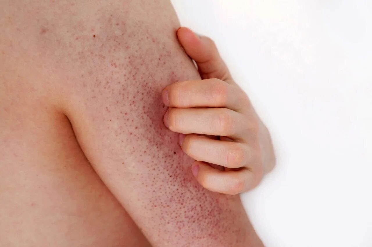 Чешется лопатки у мужчина. Keratosis pilaris (фолликулярный гиперкератоз). Фолликулярный гепотоз. Фолликулярный кератит. Фолликулярный Каритас.