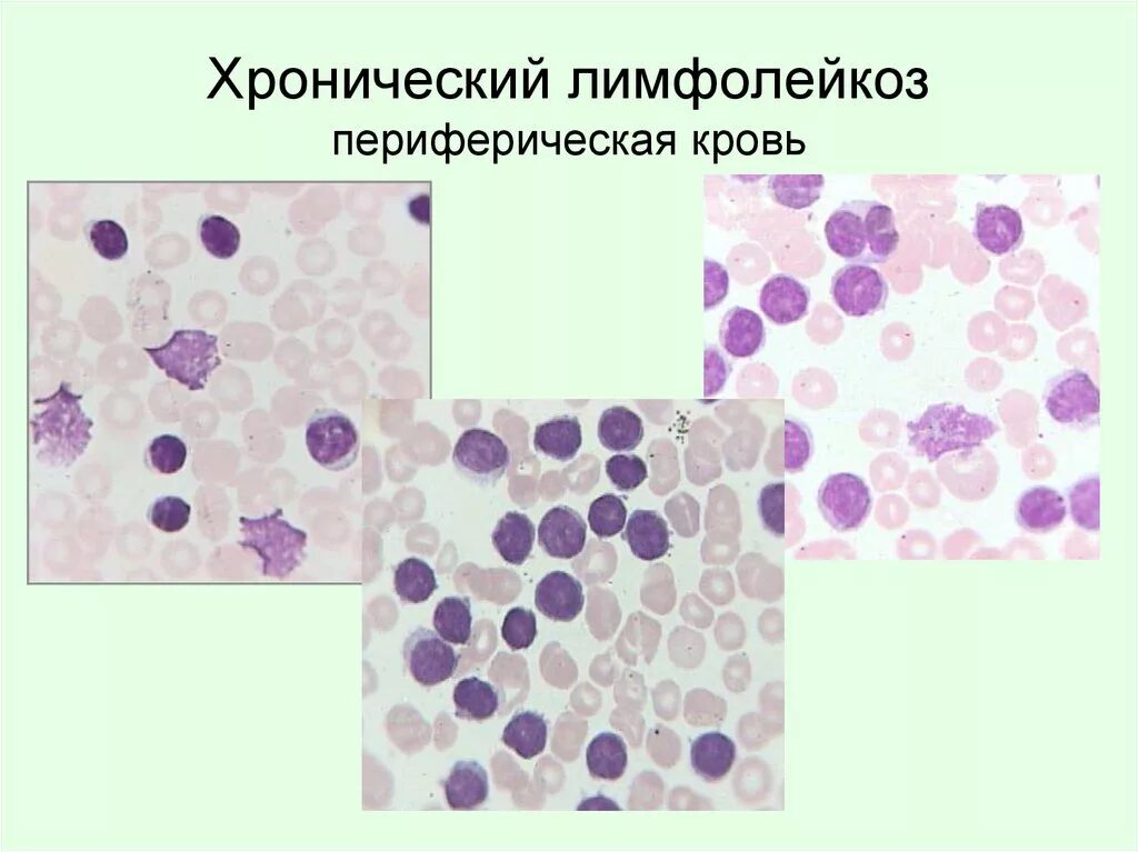 Хронический лимфобластный лейкоз картина крови. Клетки лейколиза (тени Боткина-Гумпрехта). Хронический лимфобластный лейкоз картина периферической крови. Картина периферической крови при хроническом лейкозе. Больным лимфолейкозом