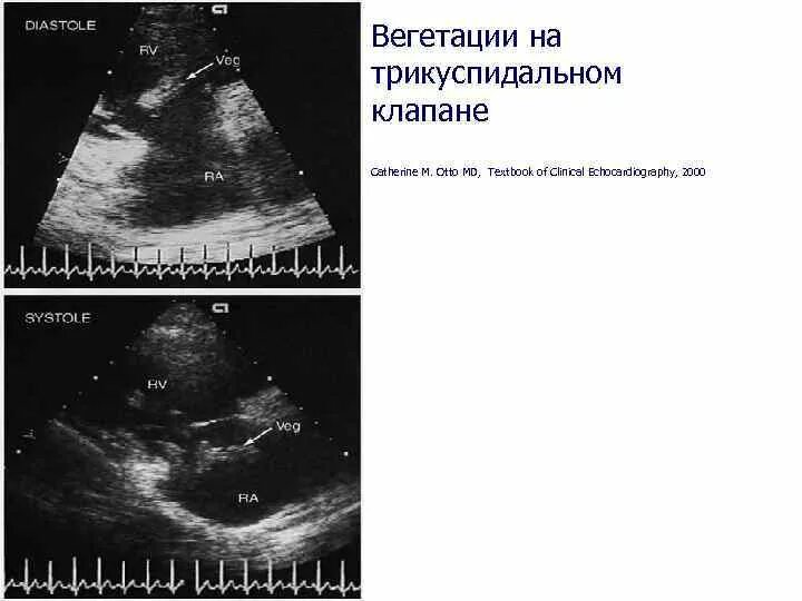 Вегетация сердца. Створки трикуспидального клапана на ЭХОКГ. Вегетации трикуспидального клапана. Трикуспидальный клапан сердца на ЭХОКГ.