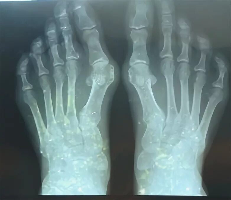 Наросты на костях фото Callus after fracture: types, causes, symptoms education, especially treatment