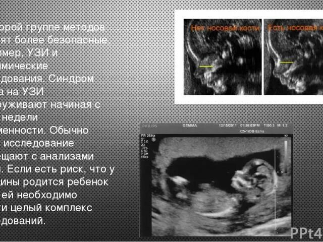 узи на дауна при беременности. признаки синдрома дауна на узи 12 недель. синдром дауна на узи 20 недель. узи плода с синдромом дауна в 12 недель. узи плода с синдромом дауна в 3 триместре.