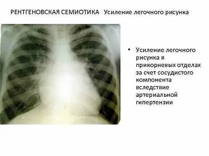 Диагноз усиление
