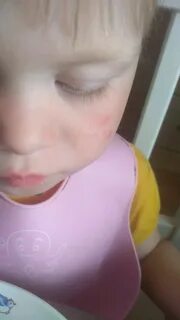На щеках у ребенка 3 года