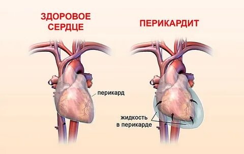 Жидкость в сердце причины