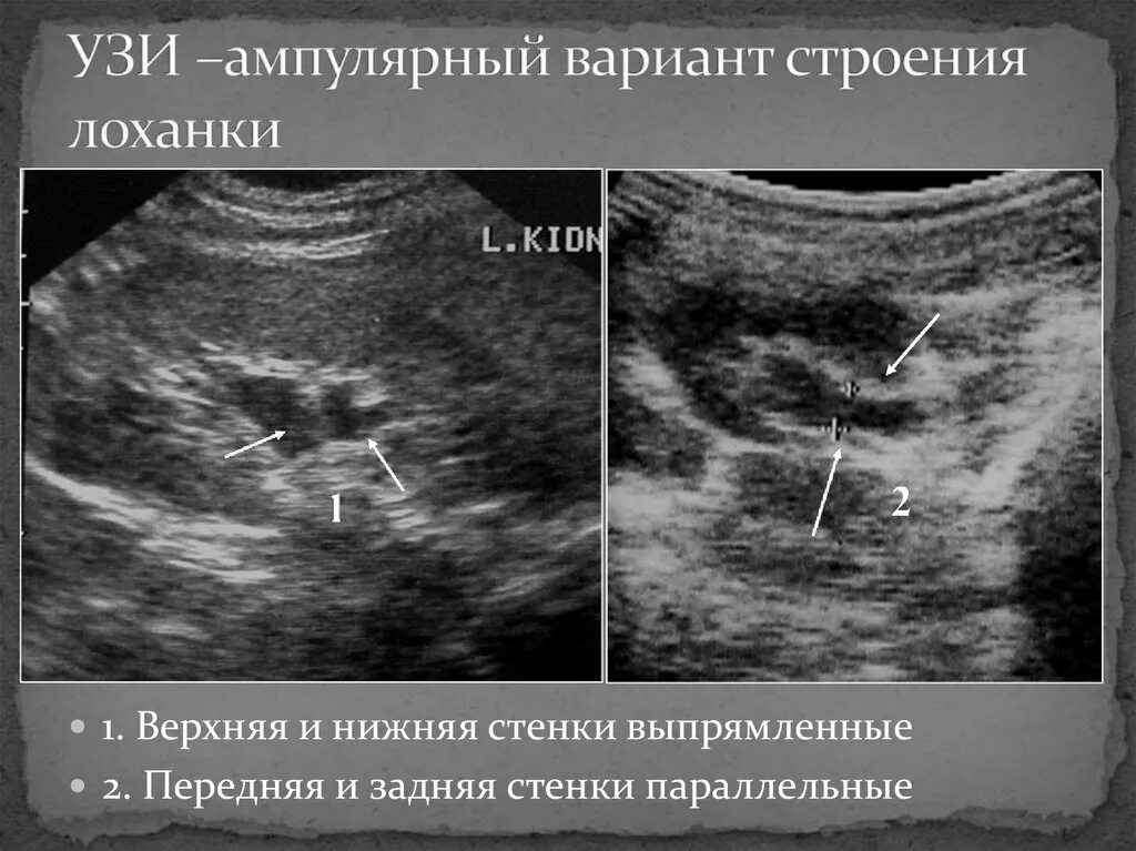 Пиелоэктазия почек на УЗИ. Измерение лоханки почки на УЗИ. Расширение лоханки на УЗИ. Расширение лоханки измерение УЗИ.