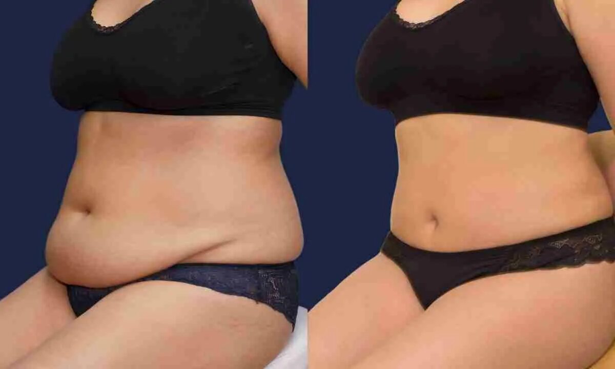 абдоминопластика живота подтяжка кожи. тумесцентная липосакция. хирургическая липосакция живота. пластическая хирургия. диастаз и пупочная грыжа.