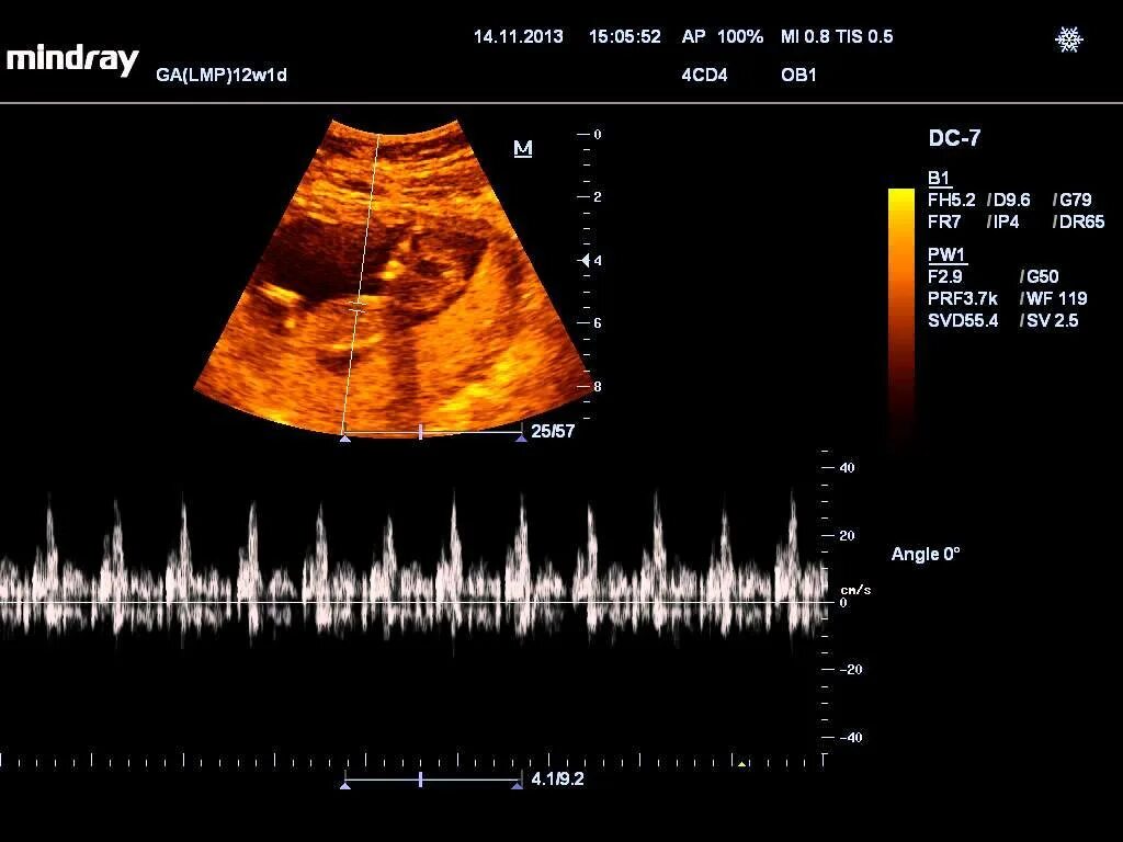 Первое сердцебиение плода. Сердцебиение плода УЗИ измерение. Первое сердцебиение плода на УЗИ. Измерение ЧСС плода на УЗИ. Измерении ЧСС плода на Уцзи.