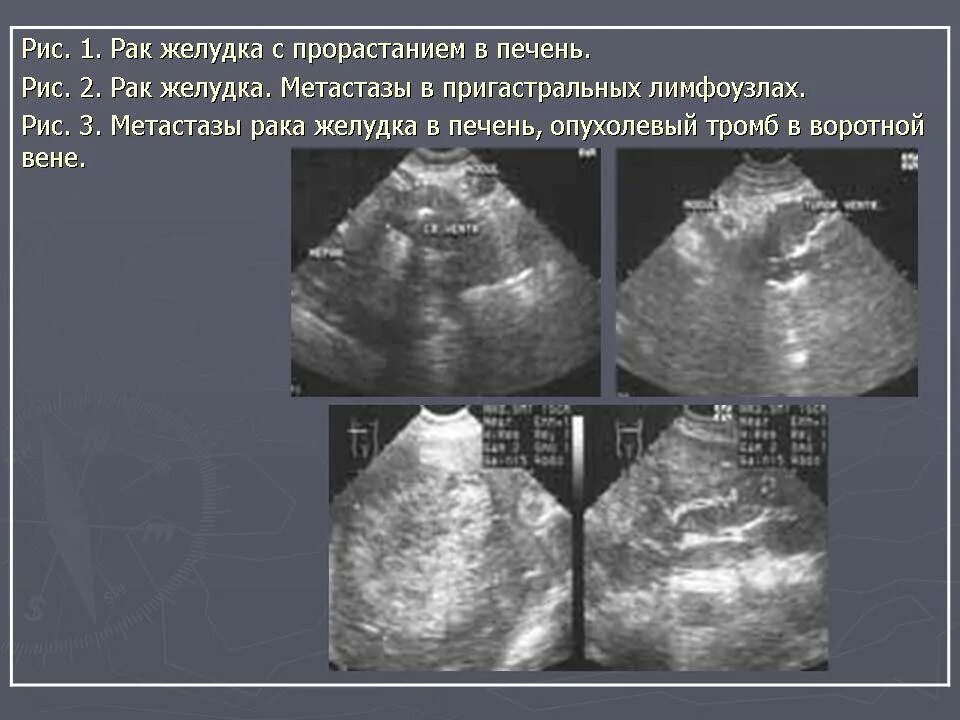 Трансабдоминальное УЗИ желудка. Желудок на УЗИ брюшной полости. Опухоль желудка эхограмма. На узи виден желудок