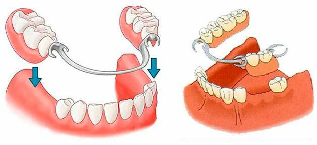 Схема крепления коронки на импланты. Частичный съемный протез бюгельный. Покрывной протез на 2 имплантах. Протез на аттачменах на имплантах. Типы фиксации коронок на имплант.