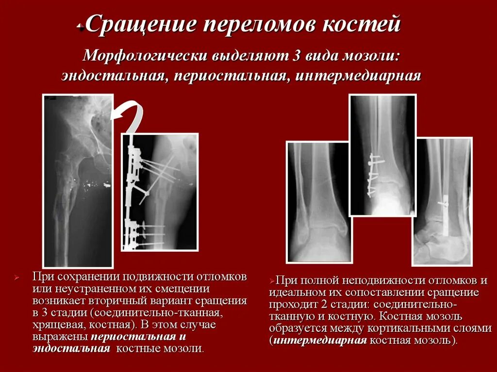 Сколько проходит трещина. Эндостальная костная мозоль. Эндостальная костная мозоль рентген. Параоссальная костная мозоль рентген. Эндостальная костная мозоль на кт.