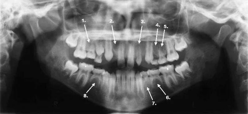 Адентия верхней челюсти. Первичная адентия зубов. Частичная первичная адентия.