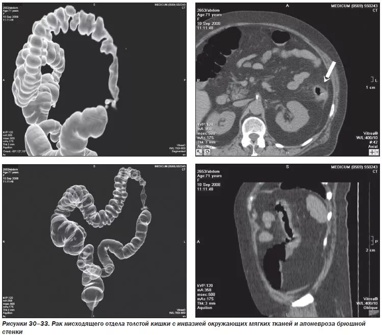 Кт виртуальная колоноскопия кишечника. Кт толстой кишки с контрастированием. Кт толстой кишки снимок. Опухоль Толстого кишечника на кт. Язва кт